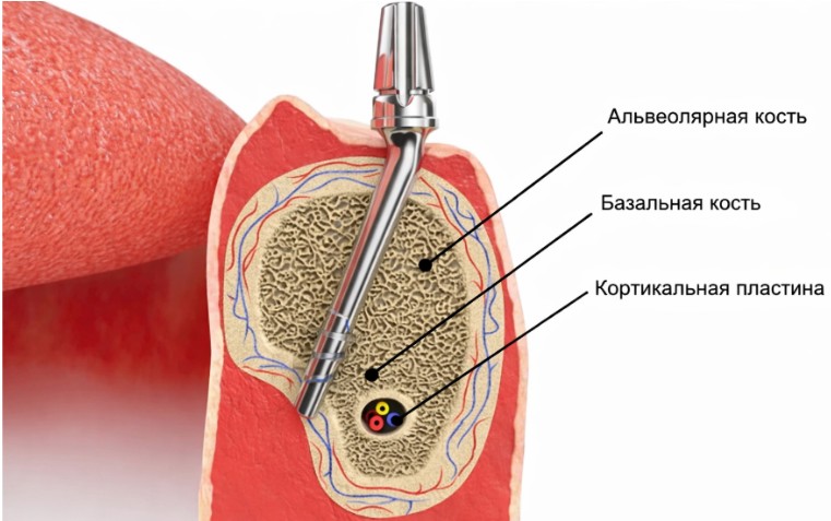 Установка имплантата при базальной имплантации