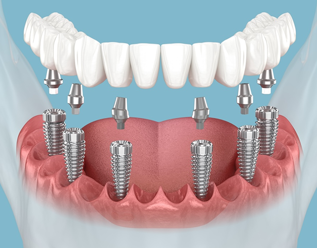 Имплантация All-ON-6 save new